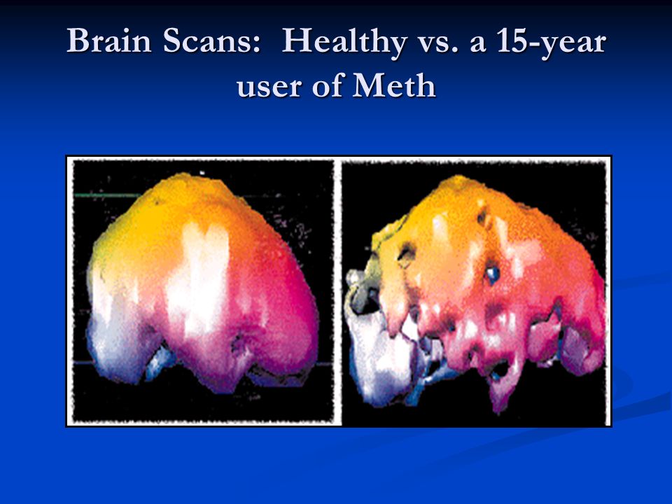 Brain+Scans:+Healthy+vs.+a+15-year+user+of+Meth.jpg