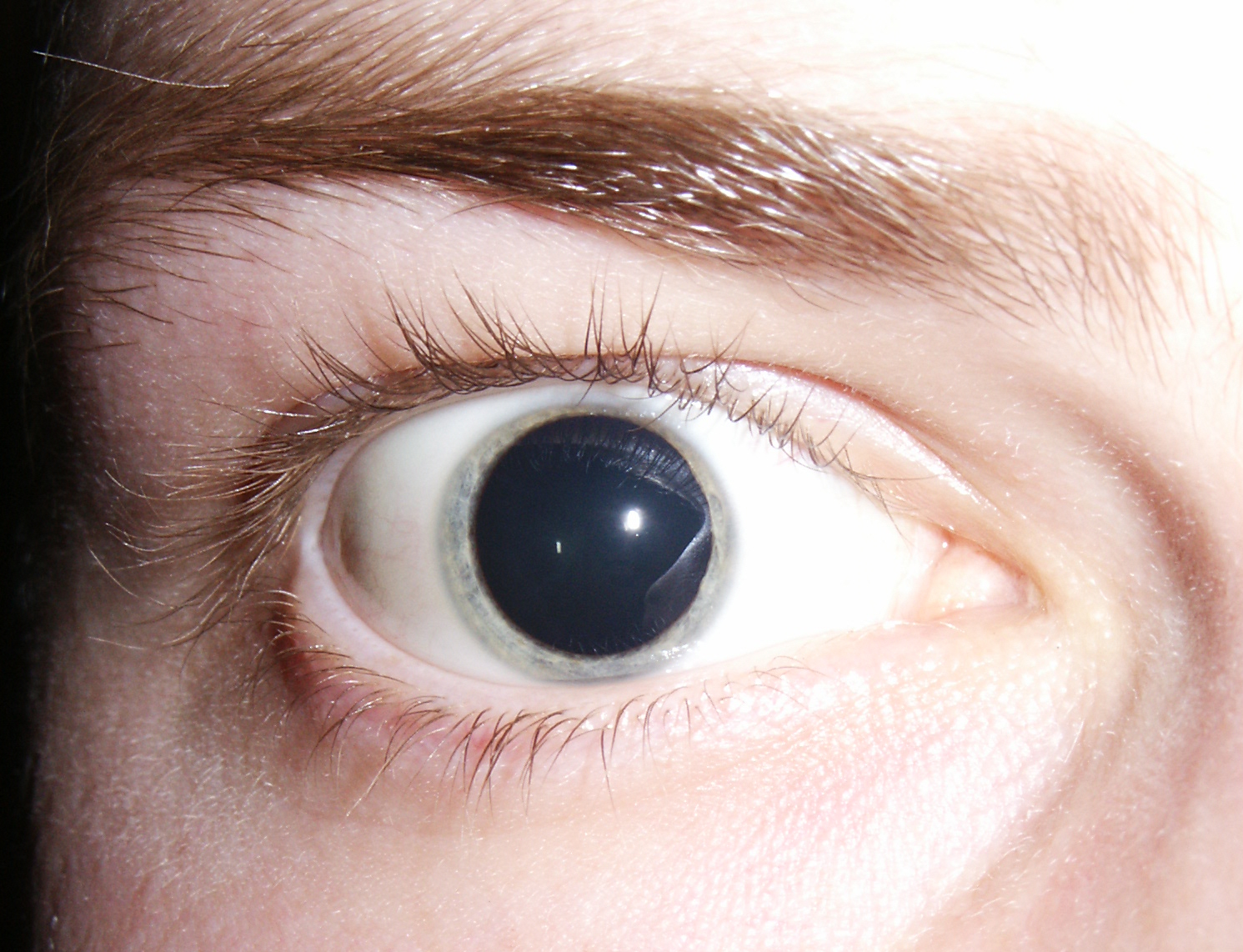 Dilated_pupils_2006_%28cropped%29.jpg