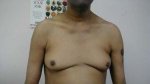 gynecomastia.jpg