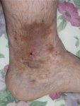 Jason's ankle.jpg