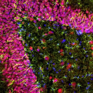 inflammation-alzheimers-nueroscineews-390x390.jpg