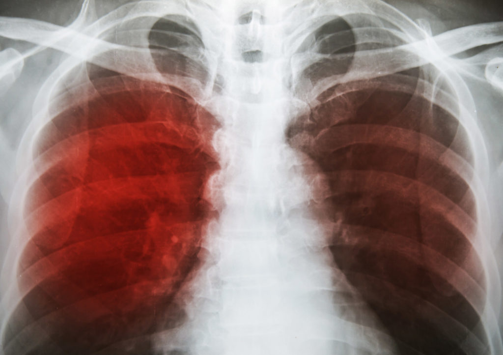 tuberculosis-x-ray-1024x722.jpg