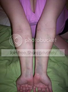 BruisedArms.jpg