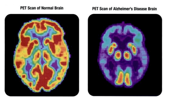 alzheimers-brain.fw_.png