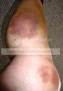 legbruise.jpg