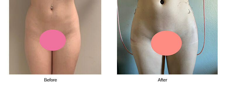hip-augmentation-3.jpg