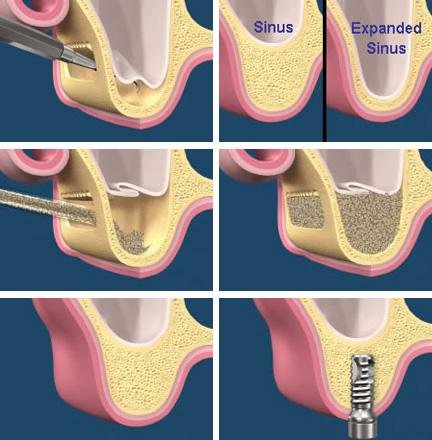 Direct-Sinus-lift.jpg