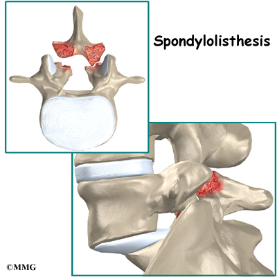 lumbar_spondylolysis_cause02.jpg