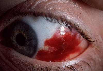 0_subconjunctival_haemorrhage-.jpg