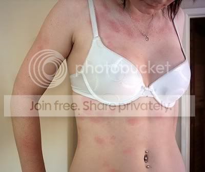 WaterAllergy.jpg