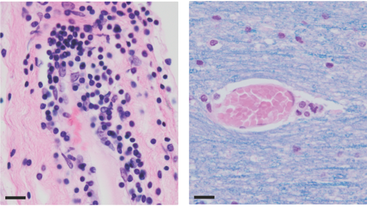 lymphocytes.png