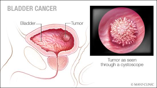 a-medical-illustration-of-bladder-cancer-original.jpg