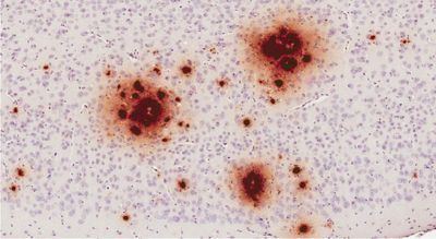 amyloid-beta-plaques-human-brain-s.jpg