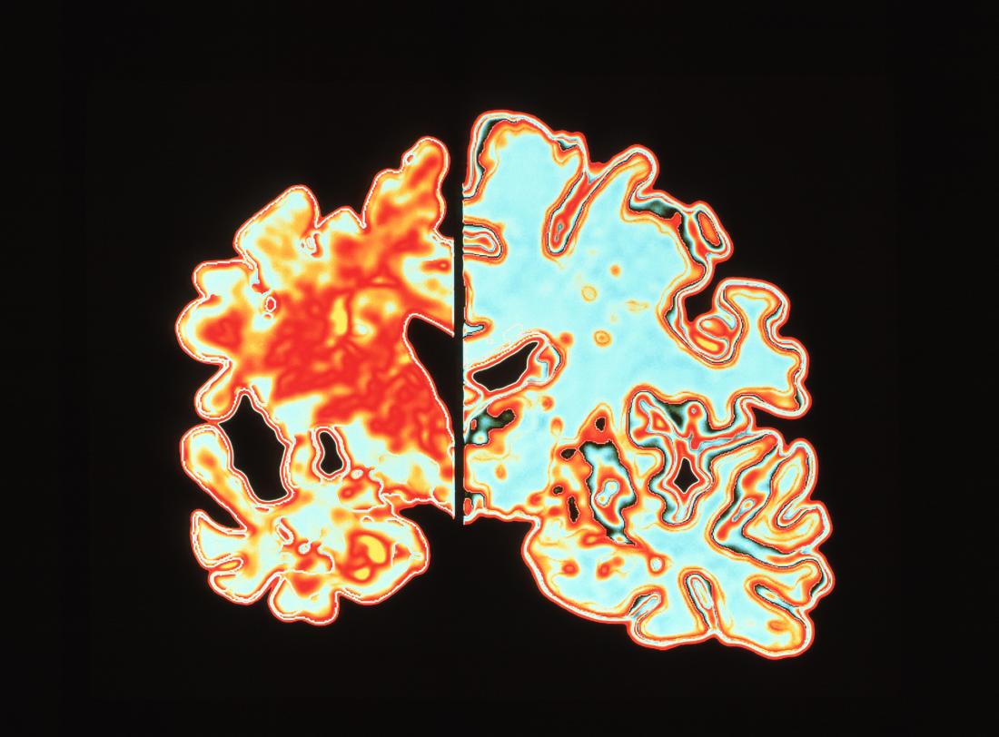dementia-alzheimer-s-brain-scan.jpg