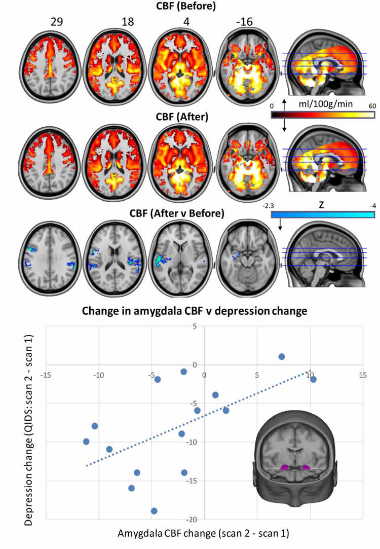depression-magic-mushroom-neurosciencenews.jpg