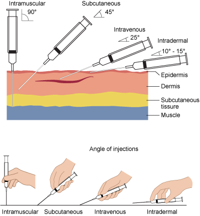needle-insertion-angles-1.png