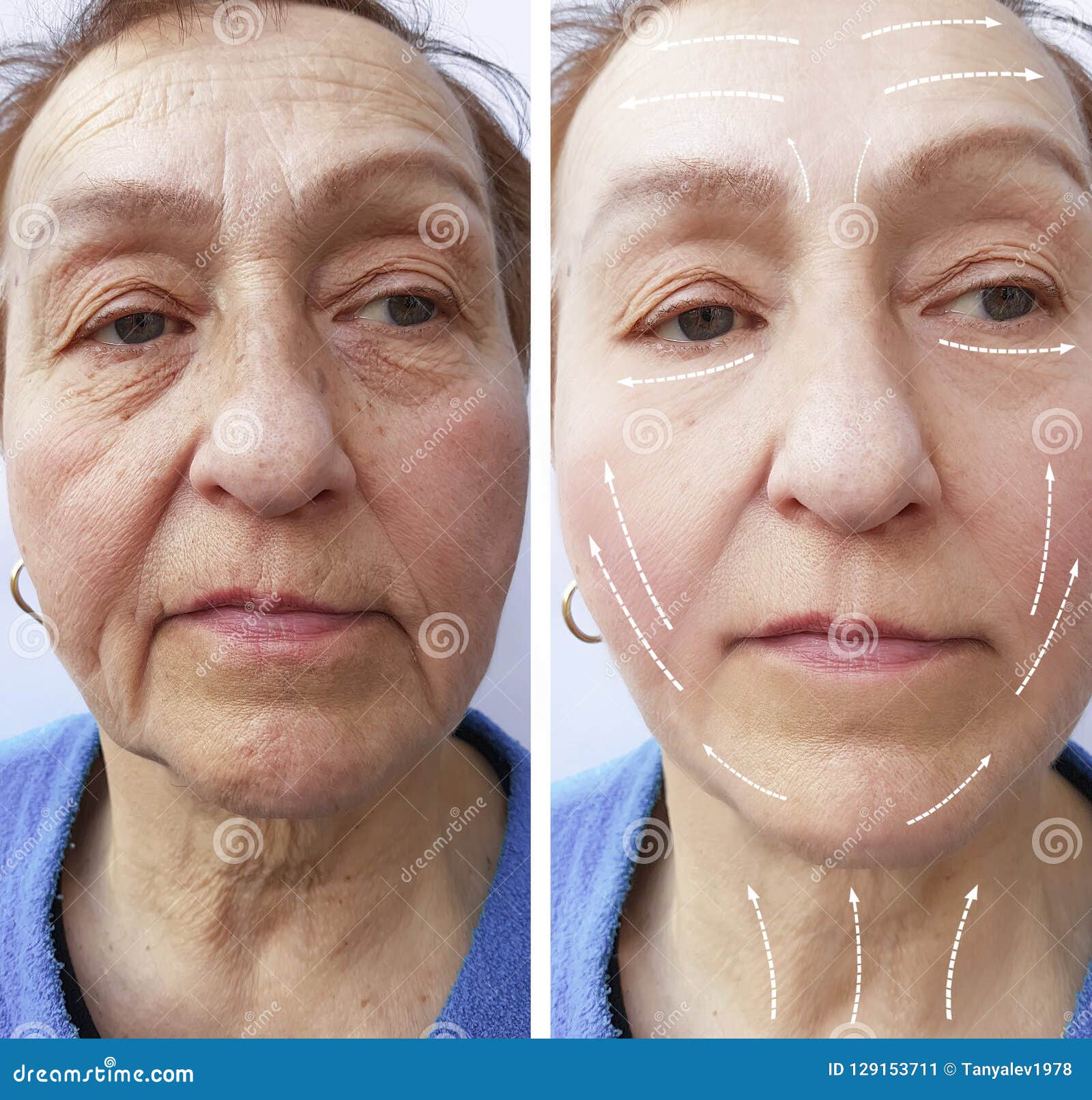 old-woman-wrinkles-filler-hydrating-procedure-old-woman-wrinkles-procedure-arrow-129153711.jpg